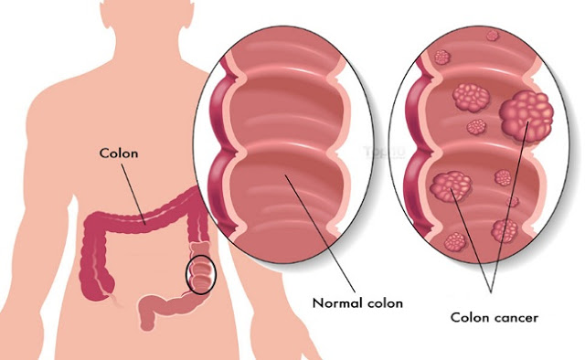 10 Warning Signs Of Colon Cancer You Shouldnt Ignore 6 Tips To Reduce The Risk 2003