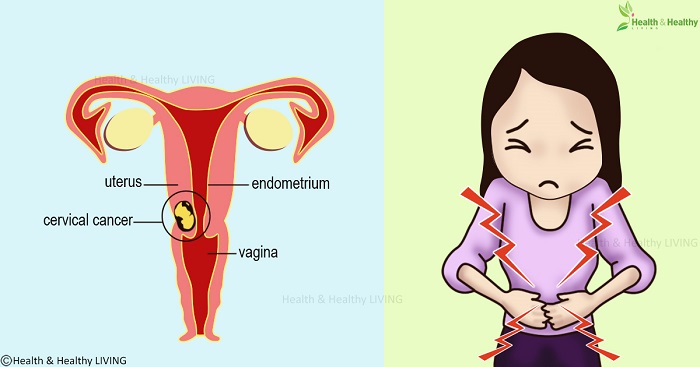 Most Women Miss These 3 Early Signs Of Cervical Cancer 