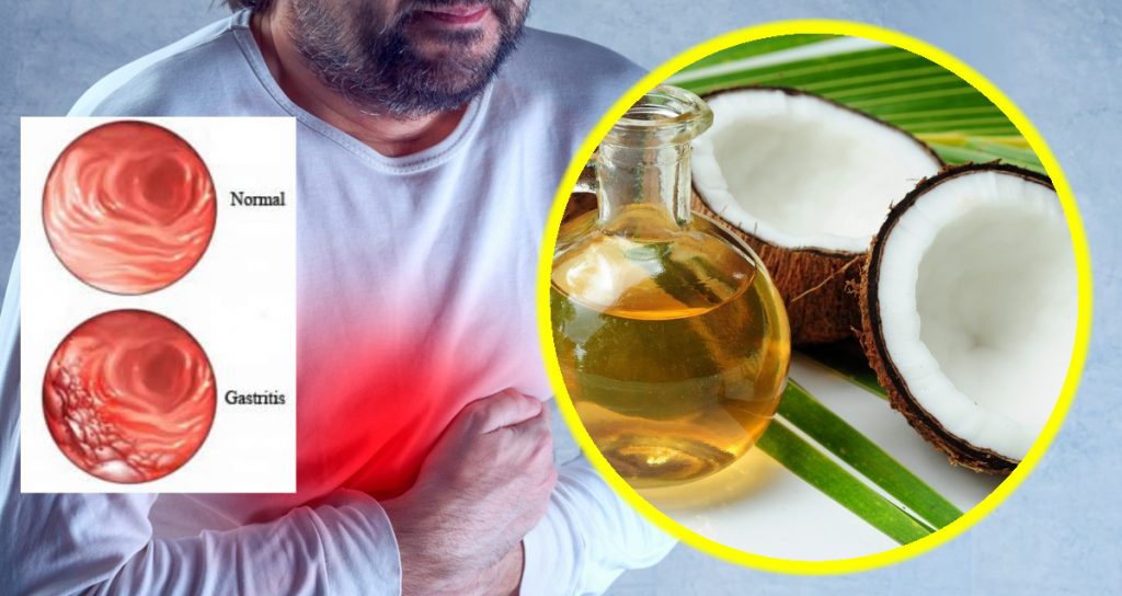 How to Diagnose and Treat Gastritis at Home